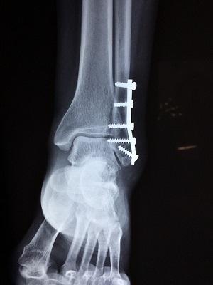 X-ray of a broken ankle
